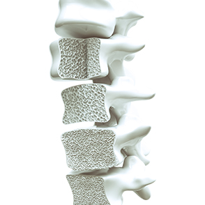 서울척병원 척추센터 척추골다공증