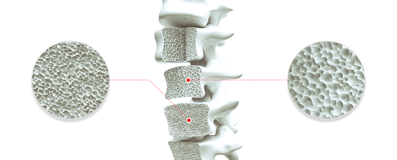 서울척병원 척추센터 척추골다공증