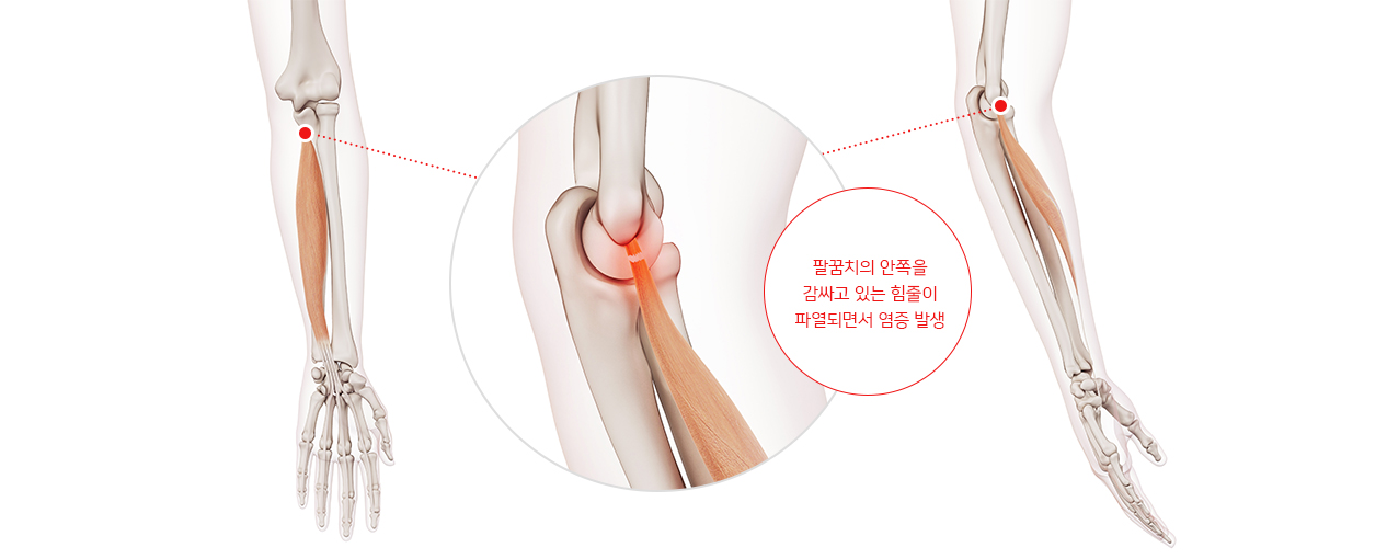 의정부 서울척병원 관절센터 테니스엘보